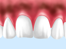 歯ぐきの黒ずみも健康的なピンク色へ