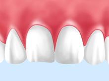 歯ぐきの黒ずみも健康的なピンク色へ