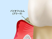 軽度の歯周病