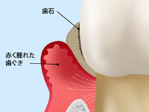 中等度の歯周病