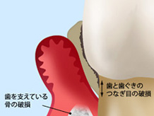 重度の歯周病