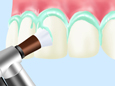 汚れのたまりやすい歯と歯ぐきの境目などを重点的に洗浄します。